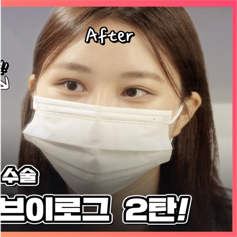 엄빠 몰래 이마거상 성공! (뒤밑트임 후기) 관련 이미지 2
