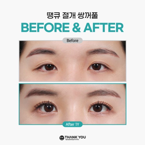 쌍꺼풀잘하는병원 땡큐에서 알려주는 절개vs비절개 수술법의 특징! 관련 이미지 10