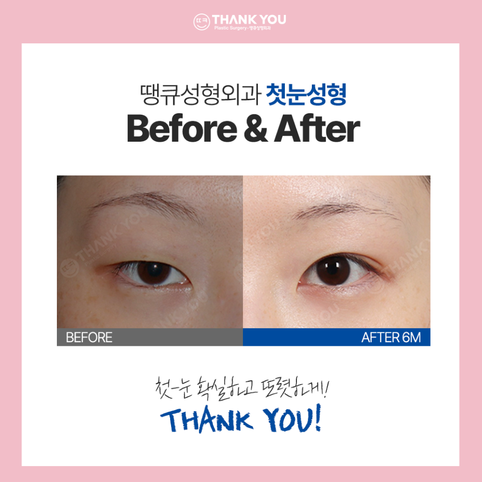 수능 끝나면 수험생 버킷리스트? 수험생 눈코 성형 전후Check 관련 이미지 6