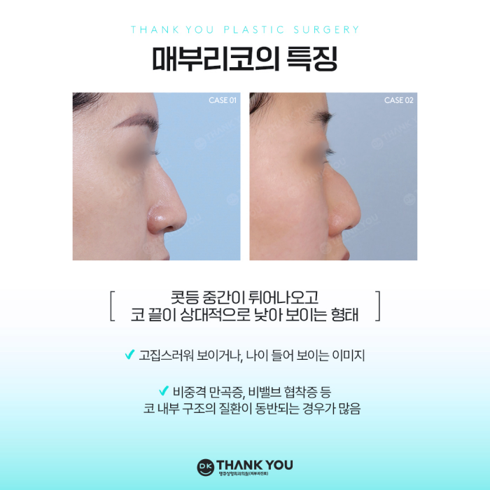 Hump Nose Improvement: Personalized Surgery Is Important! image 2