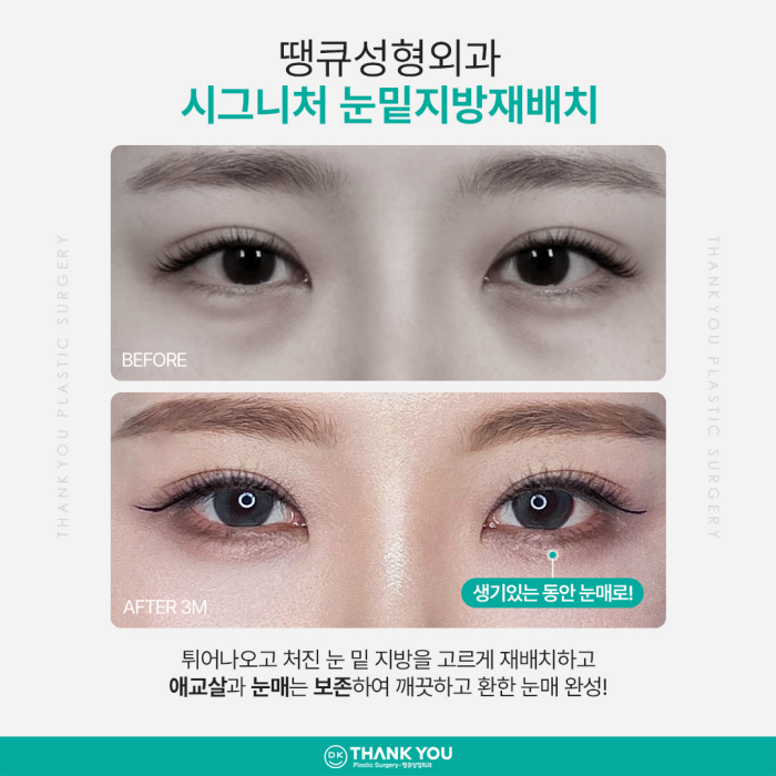 눈밑지방재배치잘하는곳은 이렇게 합니다✨✨ 관련 이미지 2