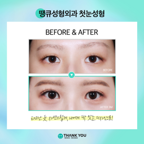 첫눈성형 성공을 위해, 눈수술 잘하는 곳 찾는 방법은? 관련 이미지 9
