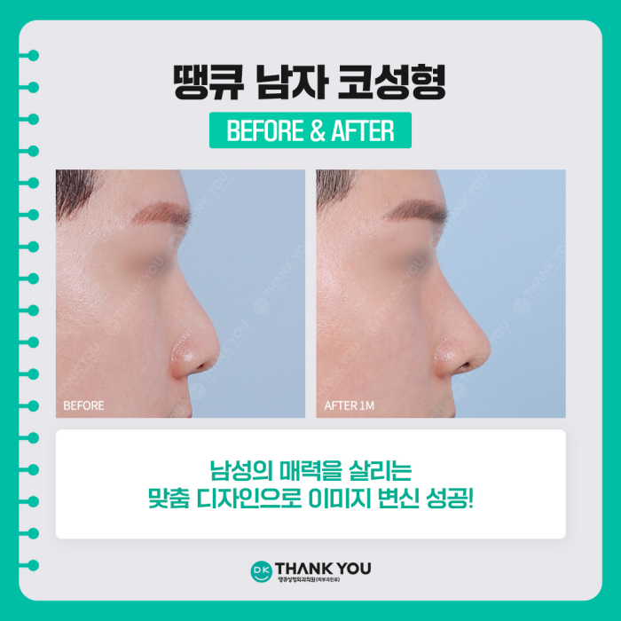 A Successful Image Transformation at Thank You, a Great Place for Male Rhinoplasty! image 6