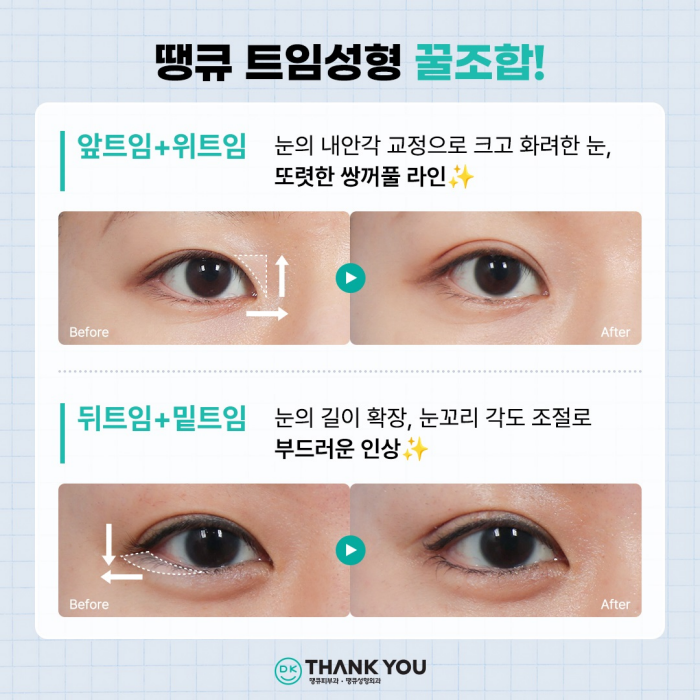 트임성형잘하는곳에서 알려주는 트임 위치별 특징 관련 이미지 10