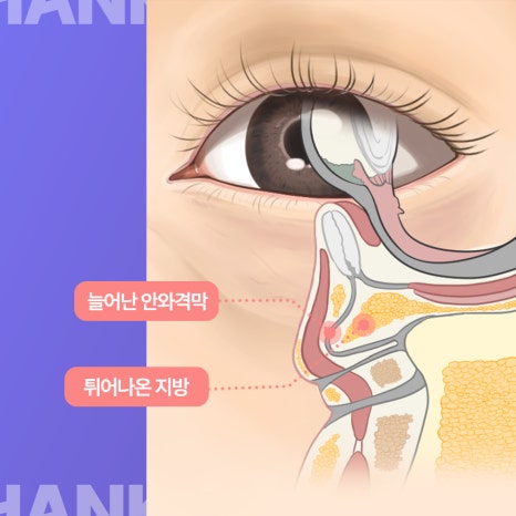 눈밑 불룩? 눈밑지방재배치 수술 후에도 재발할까? 관련 이미지 14