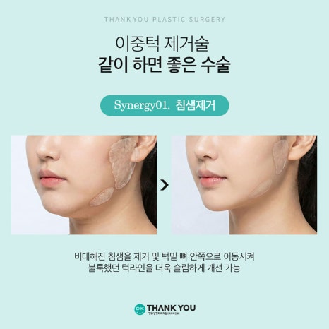 Not Enough Improvement from Chin Liposuction Alone? How About Thank You Double Chin Removal Surgery?! image 13