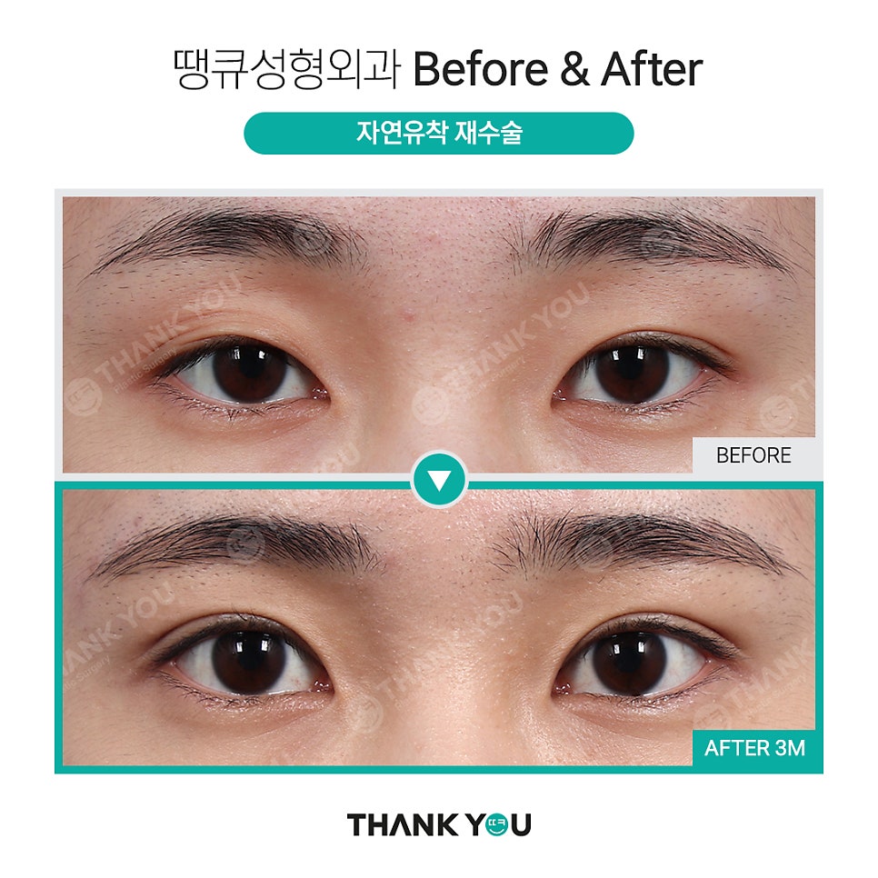 쌍수 풀기 (재수술전 실풀기+ 눈재수술 전후) 관련 이미지 3