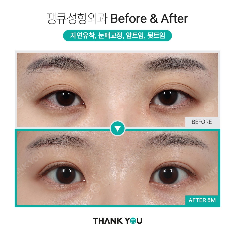 쌍수 뒷트임 (앞트임,밑트임, 듀얼트임 종류) 전후사진 관련 이미지 7