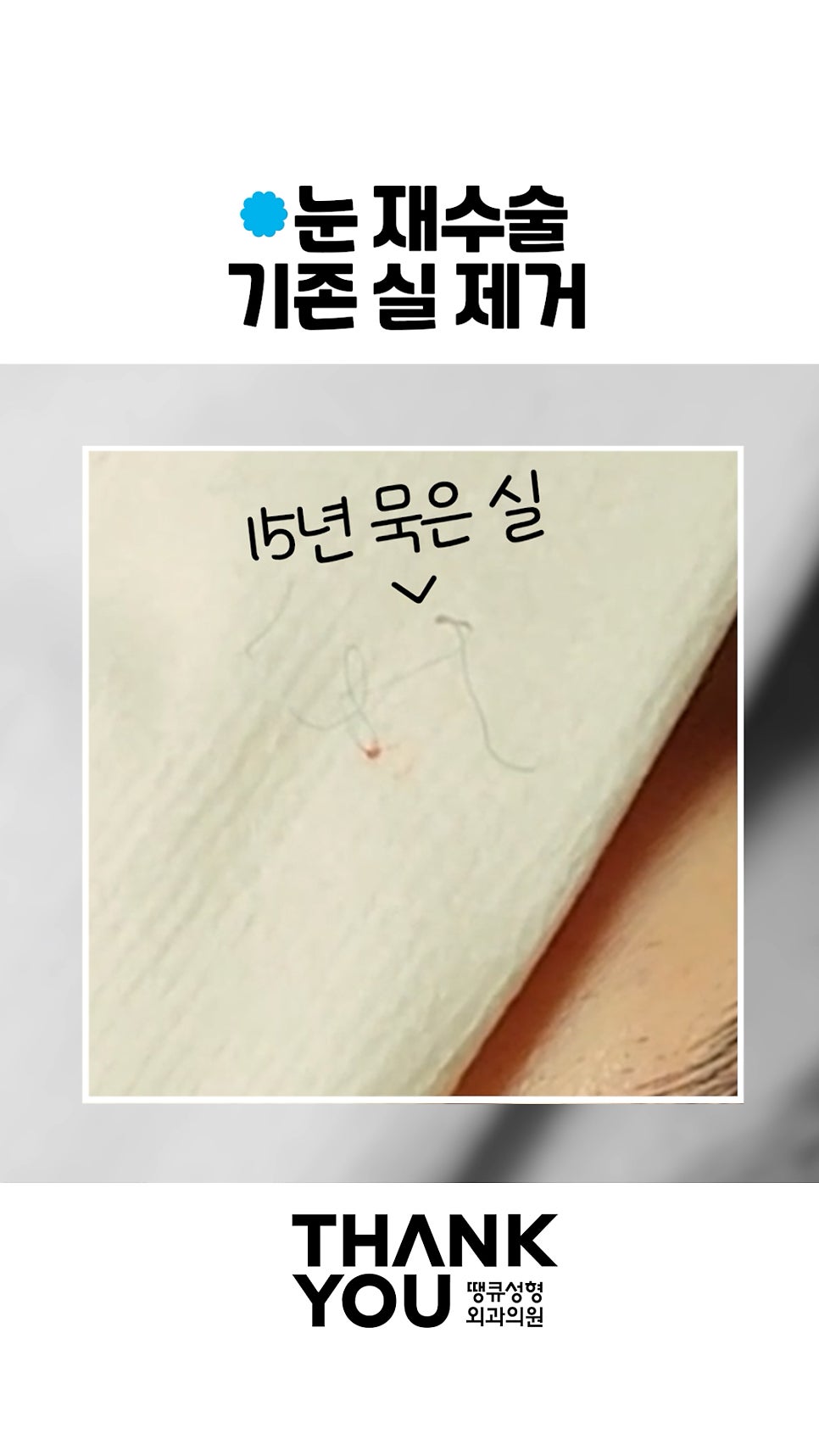 매몰 풀기, 매몰 실 제거 (15년 묵은 실)재수술 쌍꺼풀 관련 이미지 8