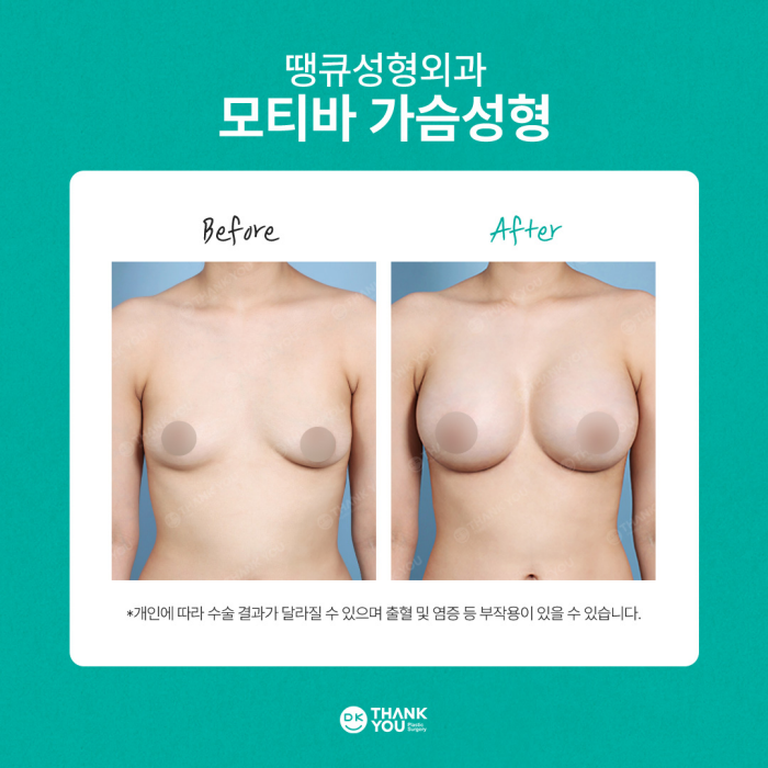 땡큐성형외과 모티바가슴성형 이벤트✨ 관련 이미지 10
