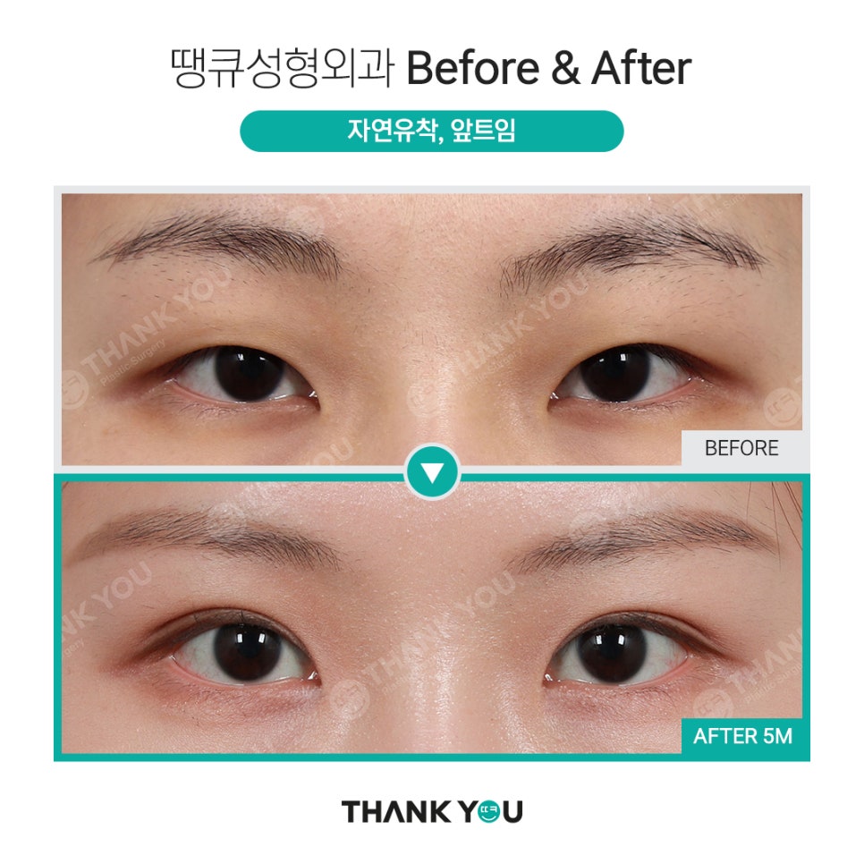 쌍수 뒷트임 (앞트임,밑트임, 듀얼트임 종류) 전후사진 관련 이미지 3