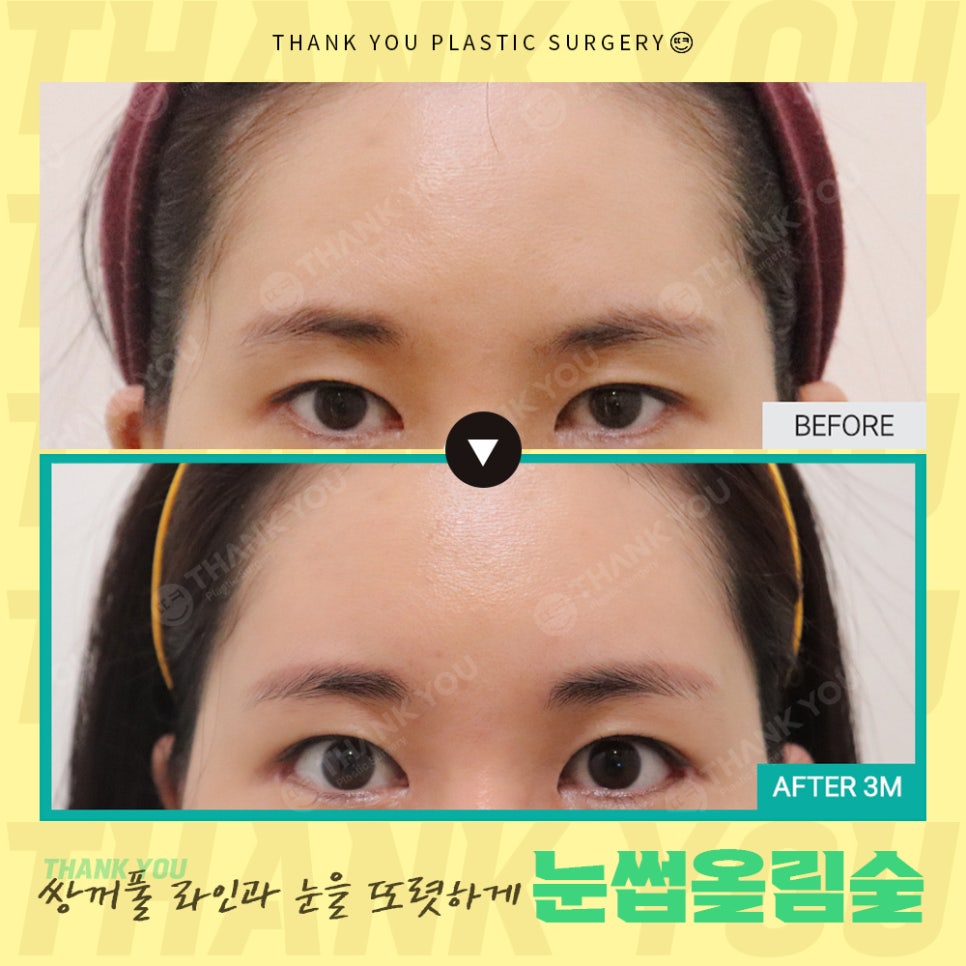 쌍수에 눈썹올림술을 추천하는 이유?! 관련 이미지 19