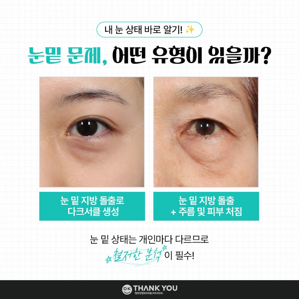 눈밑성형, 연령별로 달라지는 수술법! 무엇이 다를까? 관련 이미지 2