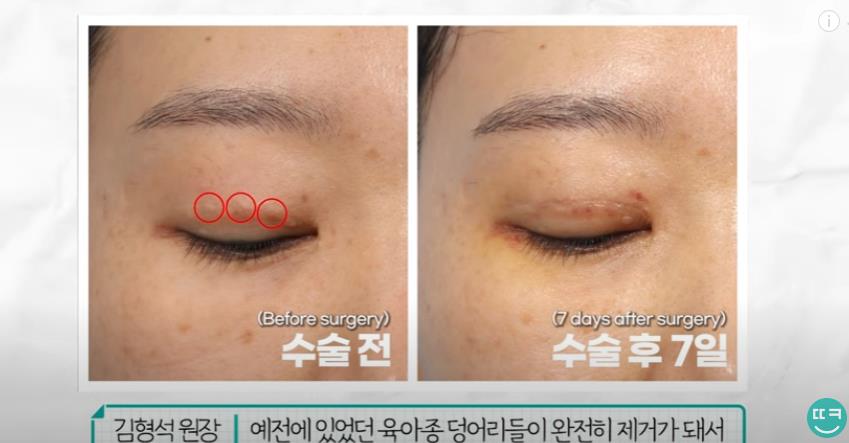 눈꺼풀에 딱딱한 여드름? 육아종 제거 [비절개] 관련 이미지 14