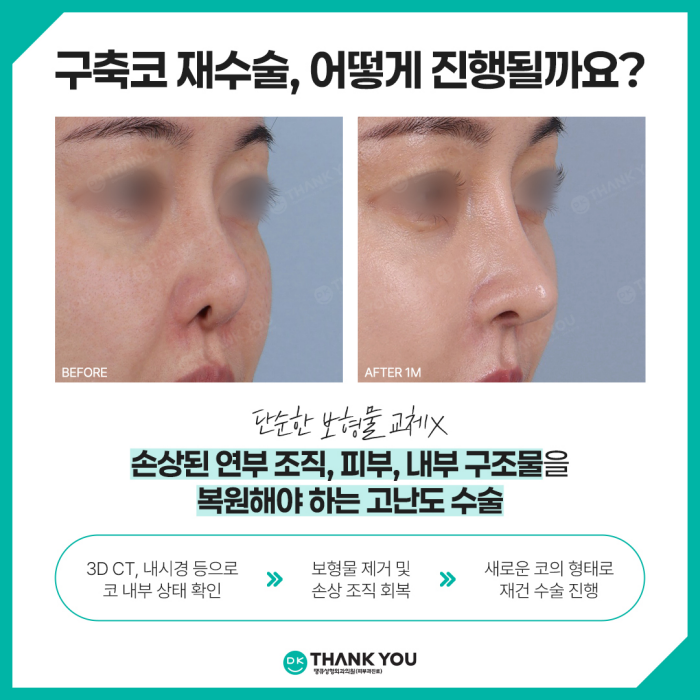 구축코재수술, 땡큐에서 받아야 하는 이유는?! 관련 이미지 3
