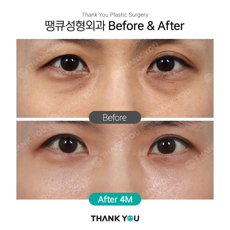 땡큐에서 알려드리는 눈밑지방재배치 Check point ❗ 관련 이미지 3