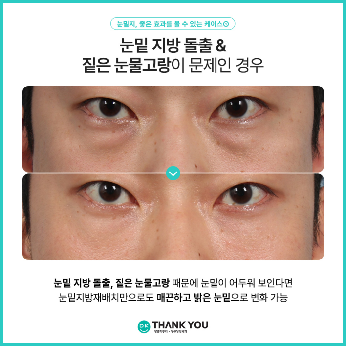 눈밑지병원에서 알려주는 눈밑지방재배치 추천 대상! 관련 이미지 3