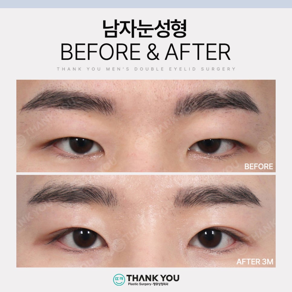 땡큐 남자눈성형 솔루션 (ft. 남자비절개 눈매교정 전후) 관련 이미지 12