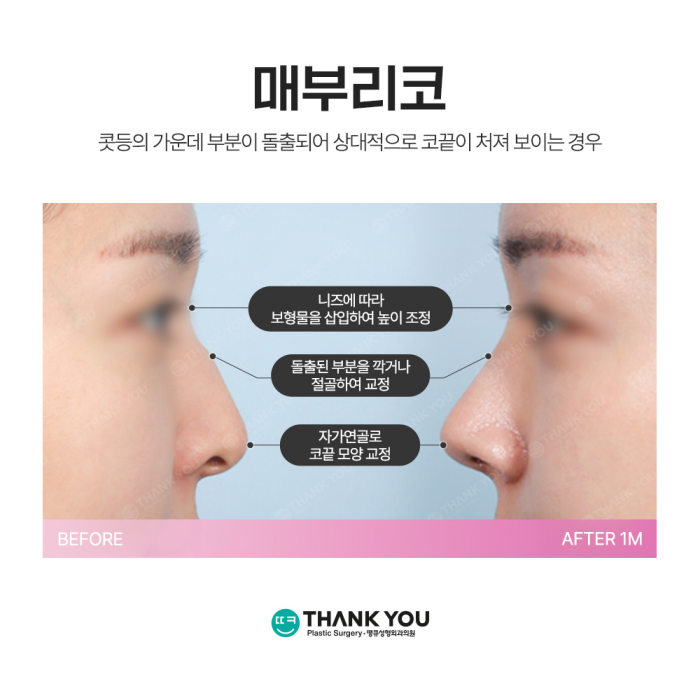 매부리코성형, 개인 맞춤 수술로 만족도 UP! 관련 이미지 3