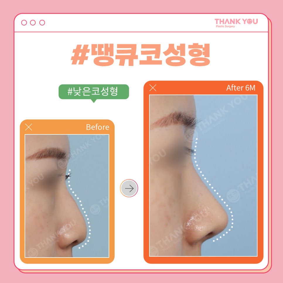 코성형 전후, 코모양 신논현역 성형외과에서 체크 관련 이미지 11