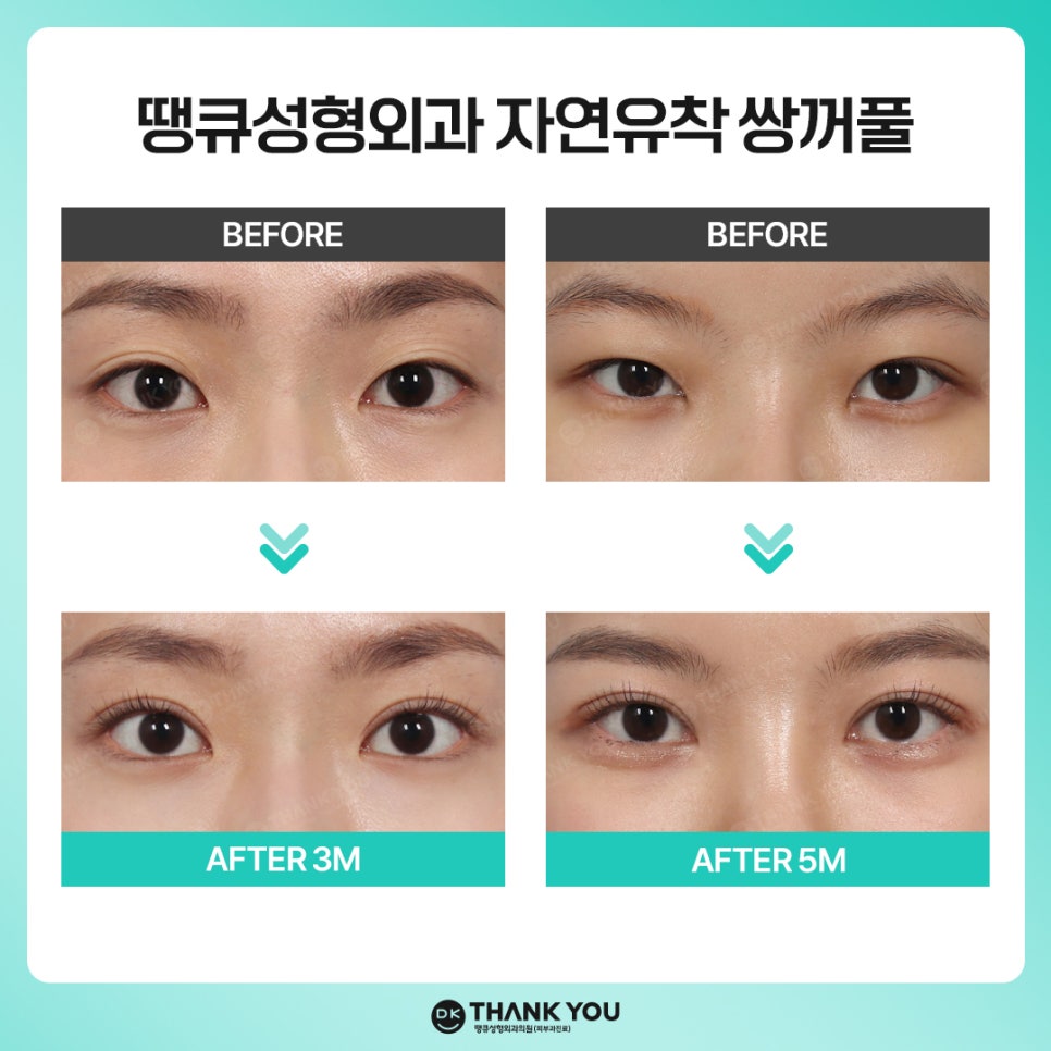 자연유착쌍꺼풀 후기 좋은 곳 땡큐에서 예뻐질 시간💖 관련 이미지 8
