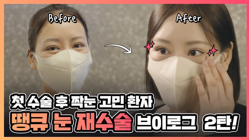 짝눈 교정, 쌍꺼풀 재수술로 깔끔하고 예쁜 라인으로 관련 이미지 1