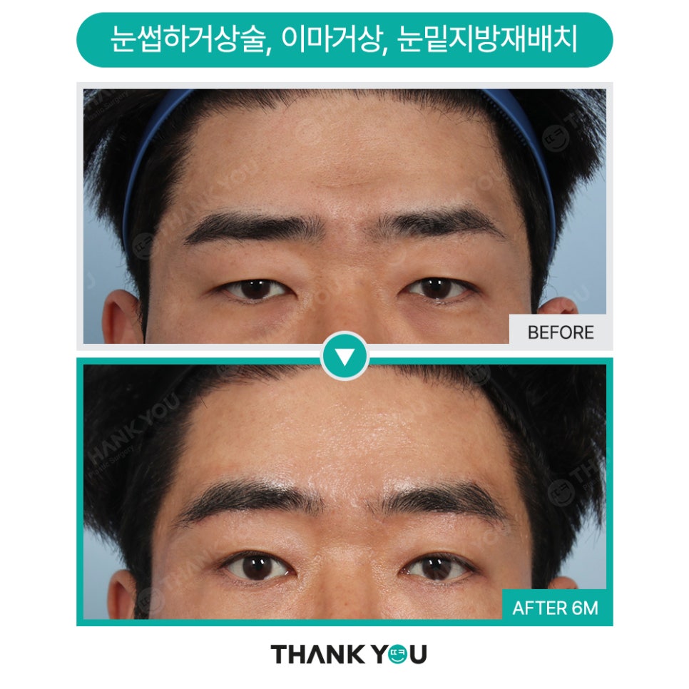 눈밑지방재배치 함께 필요한 미세 지방이식?(땡큐 나노펫) 관련 이미지 11
