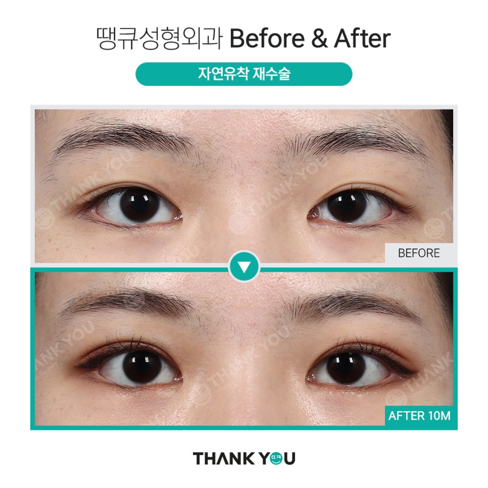 실패한 쌍수(겹주름) 눈성형 재수술 전후 사진 Point✨ 관련 이미지 2