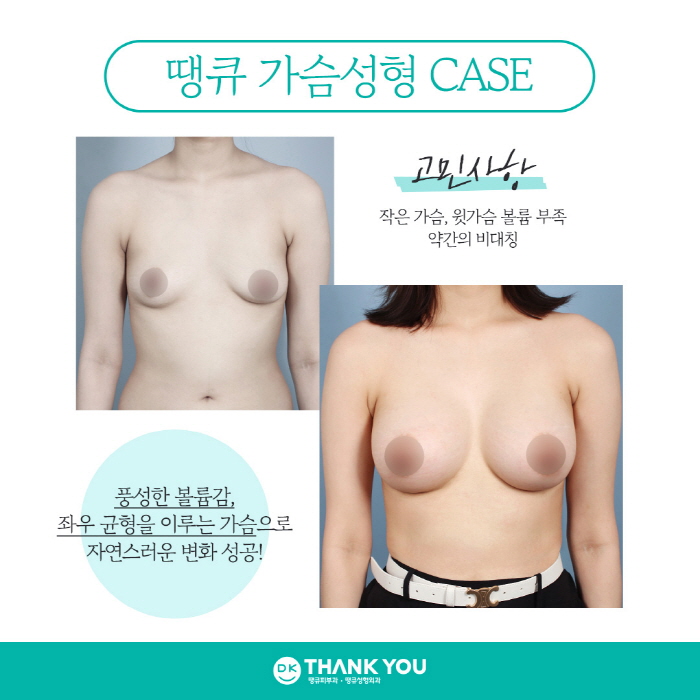 가슴성형잘하는곳에서 알려주는 가슴보형물 별 특징! 관련 이미지 2