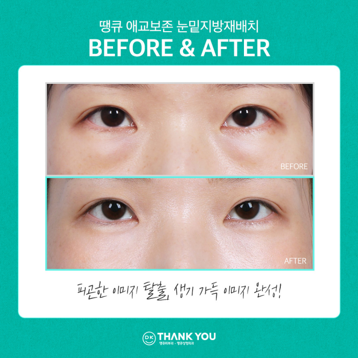 눈밑꺼짐수술? 눈밑지병원에서 내게 딱 맞게! 관련 이미지 5