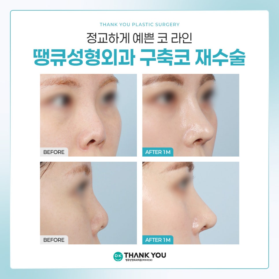 What Does a Contracted Nose Mean, and How Is Revision Surgery Performed? ❓Why Stem Cell Treatment Is Gaining Attention image 11