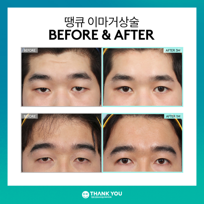 What Are the Effects of a Forehead Lift?[Column by Director Kim Gyu-beom] image 6