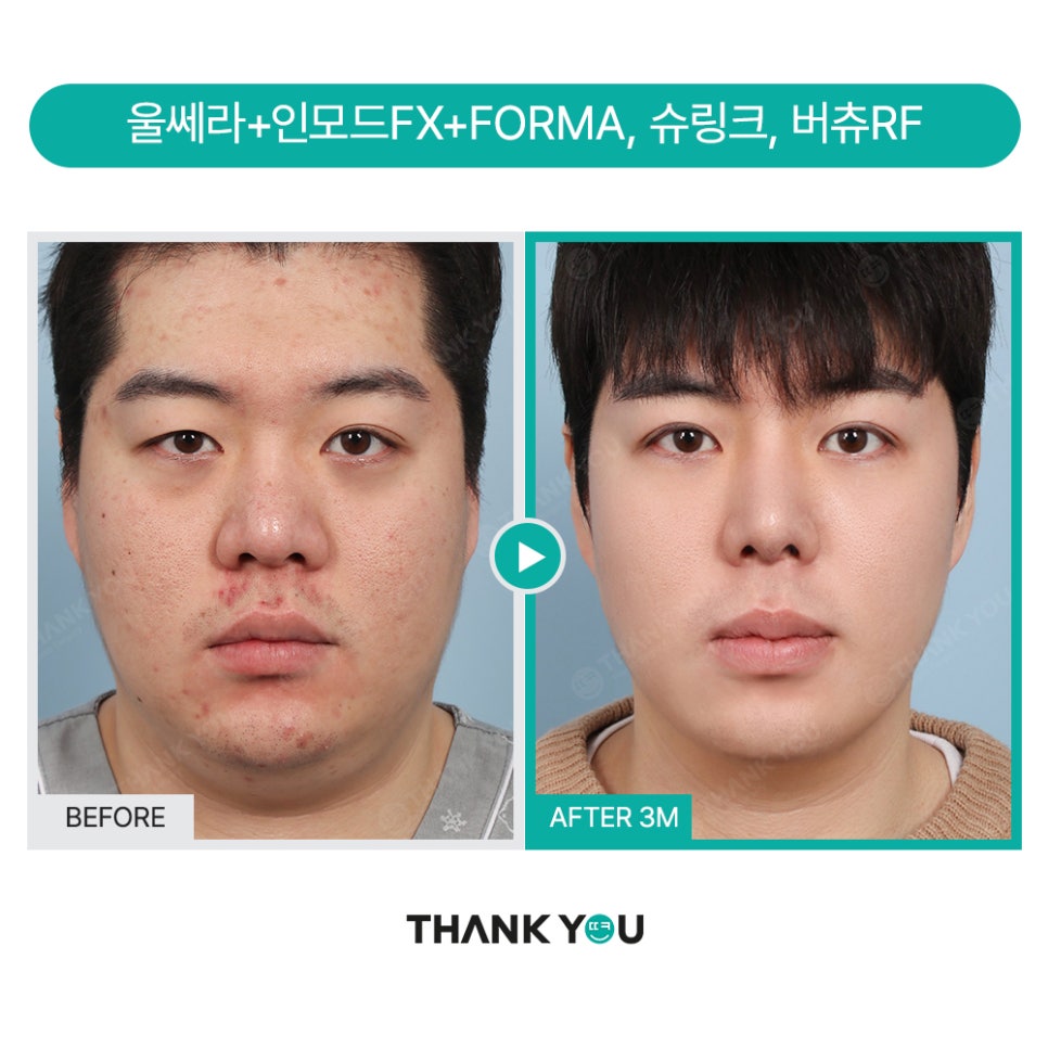 땡큐 맥미남, 뮤지컬배우 남자 복부지방흡입 전후 Check 관련 이미지 17