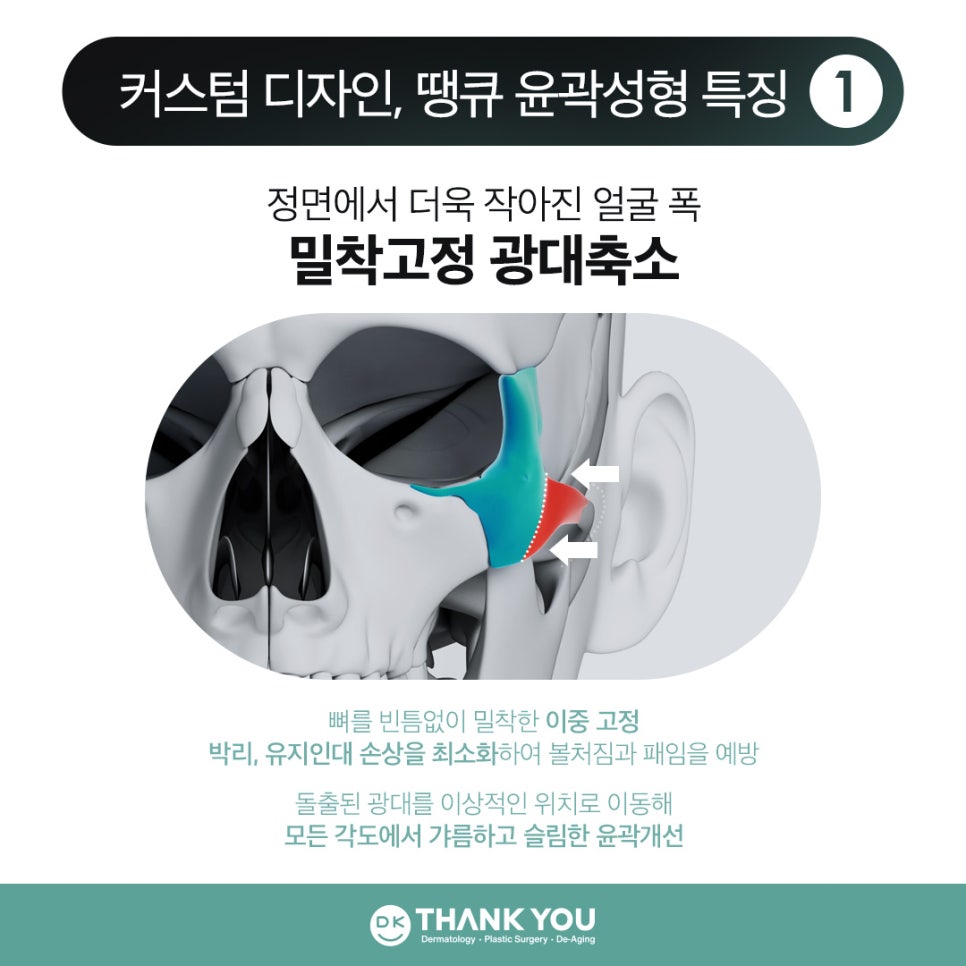 땡큐 윤곽성형 이벤트로 굴곡 없이 작고 매끈한 얼굴 만들기! 관련 이미지 5