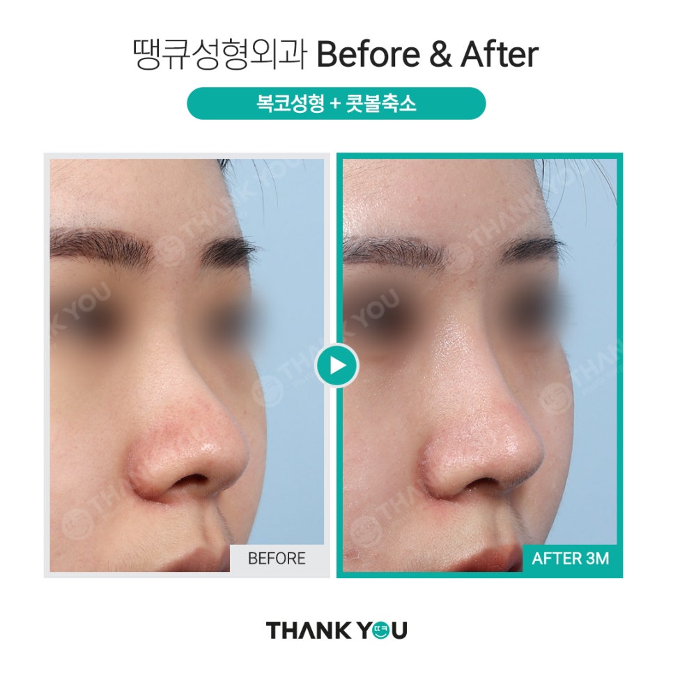 코 재수술시 기존 실리콘은 꼭 제거해야 되나요? 관련 이미지 10