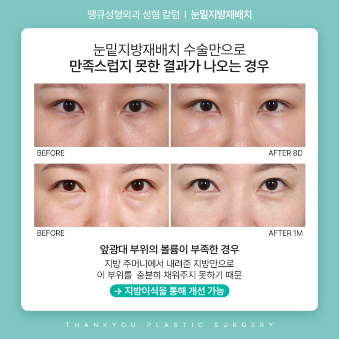 눈밑지방재배치수술만으로 볼륨이 부족하다면? 관련 이미지 4