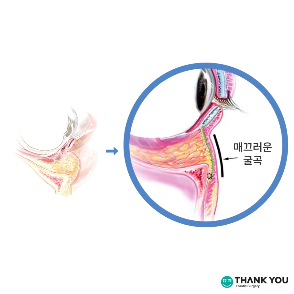 눈밑성형에 격막 강화란 무엇인가요? [눈밑지] 관련 이미지 10