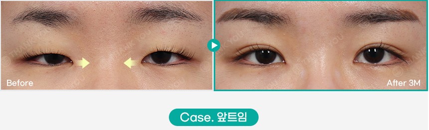 가로로 긴 눈은 어떤 쌍꺼풀라인이 어울릴까요? 관련 이미지 3