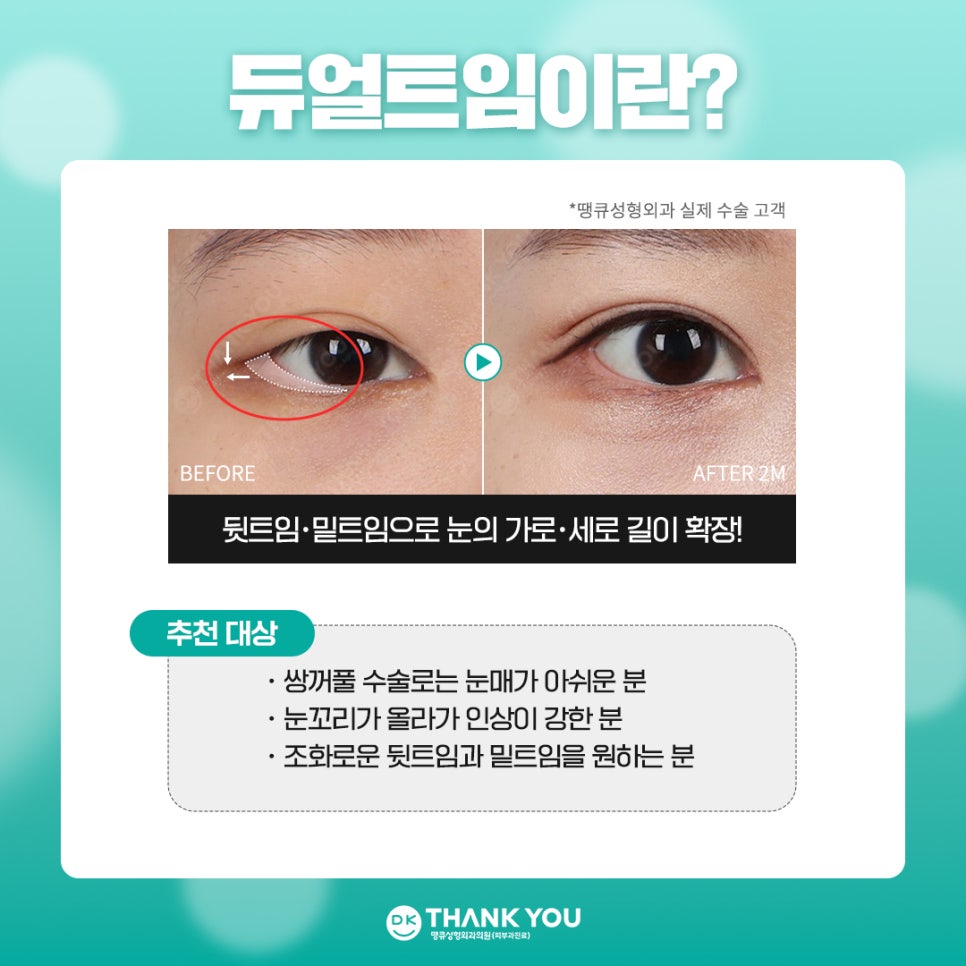 눈트임수술 [땡큐 팝콘트임]으로 듀얼트임 효과내기✨ 관련 이미지 2