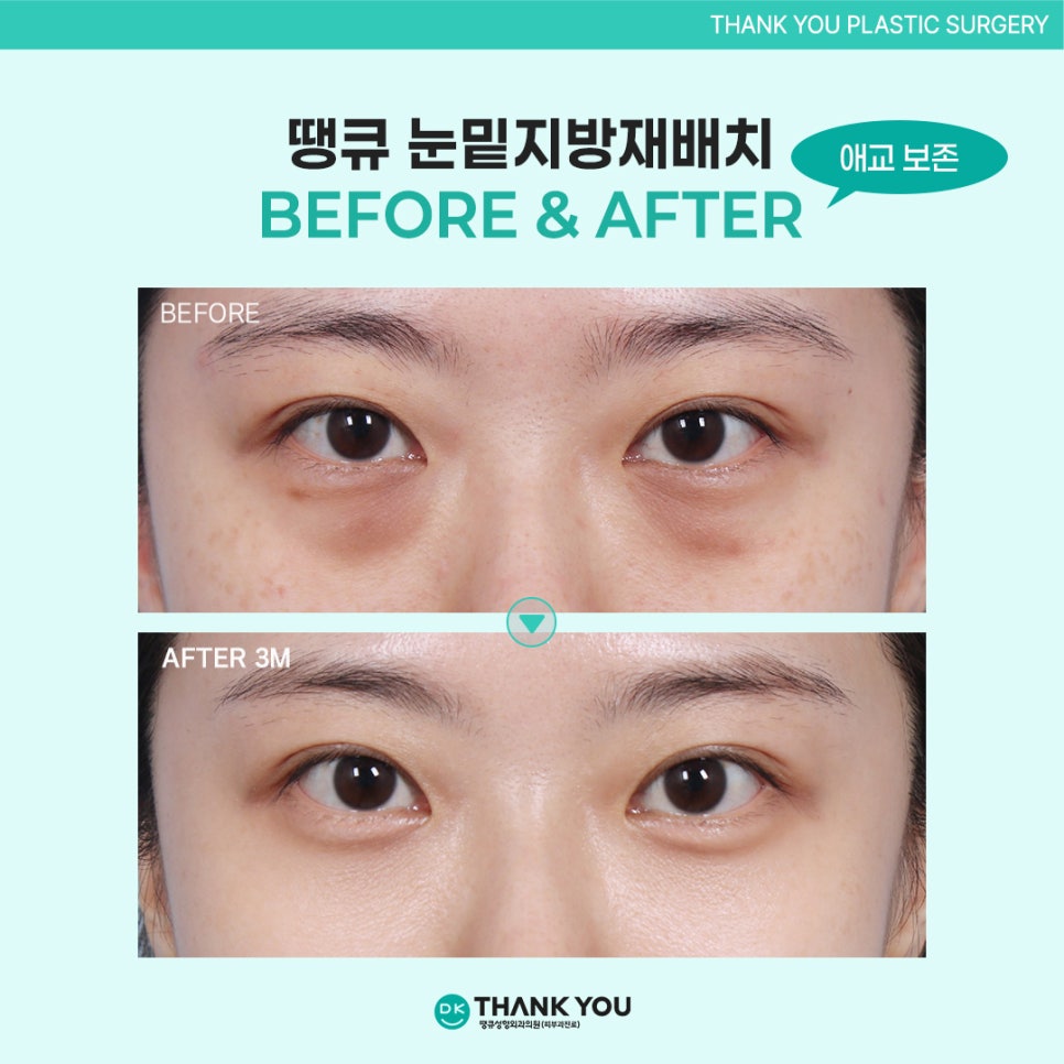 눈밑지방재배치효과? 수술 잘하는 곳 땡큐에서 확인! 관련 이미지 12