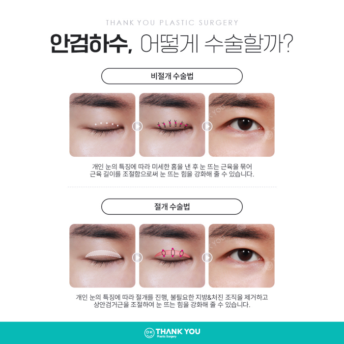 기능눈성형 근본적인 원인을 개선해야 해요! 관련 이미지 10