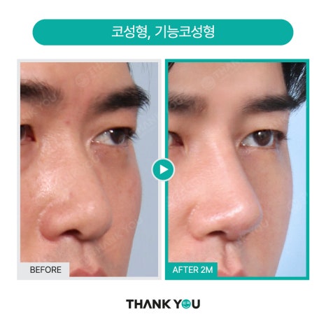 [맥미남 병원] 남자 휜코 성형, 막힌코수술, 코막힘 등 전후 까지 관련 이미지 10