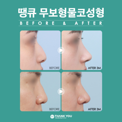 무보형물코성형 재료에 따른 특징을 알아보자! 관련 이미지 8