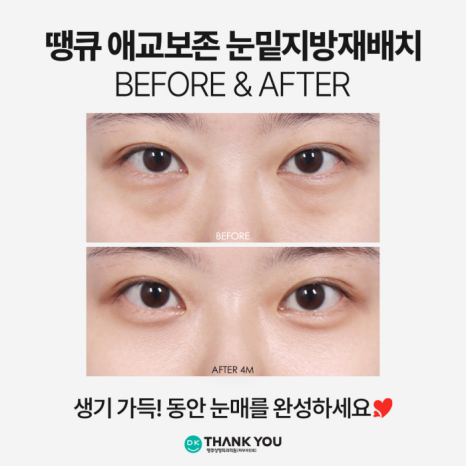 눈밑지전후 애교살에 변화가 생길까? [김다솜 원장 칼럼] 관련 이미지 9