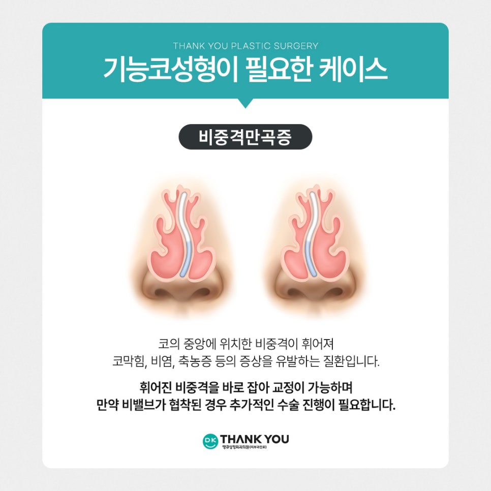 기능코성형, 비염수술코성형 유형별 수술법 알아보기 관련 이미지 5