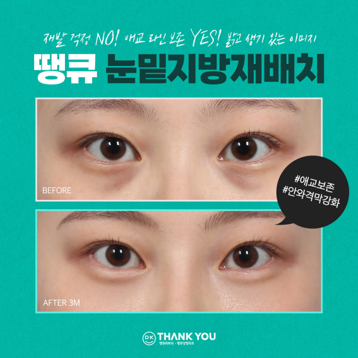 눈밑꺼짐수술? 눈밑지병원에서 내게 딱 맞게! 관련 이미지 1