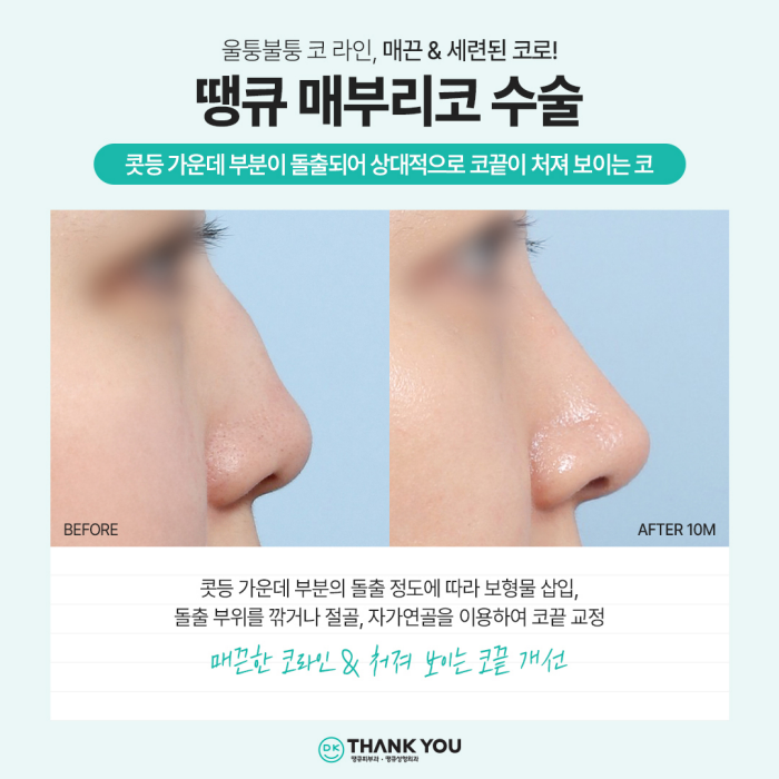 강남코성형 성공 방법은?! 코성형잘하는병원과 함께! 관련 이미지 3