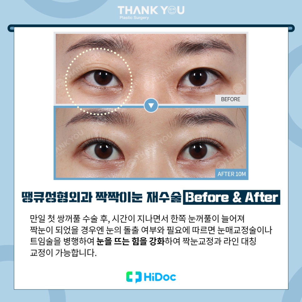 강남 눈재수술, 짝짝이눈 교정 방법 라인 대칭 성공 포인트 관련 이미지 7