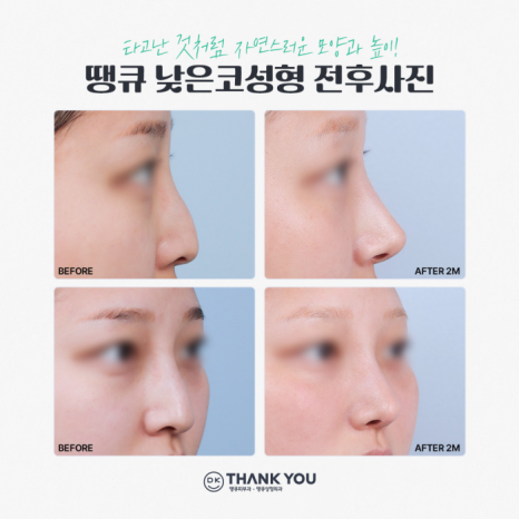 낮은코성형 내게 맞는 높이와 모양으로 관련 이미지 6