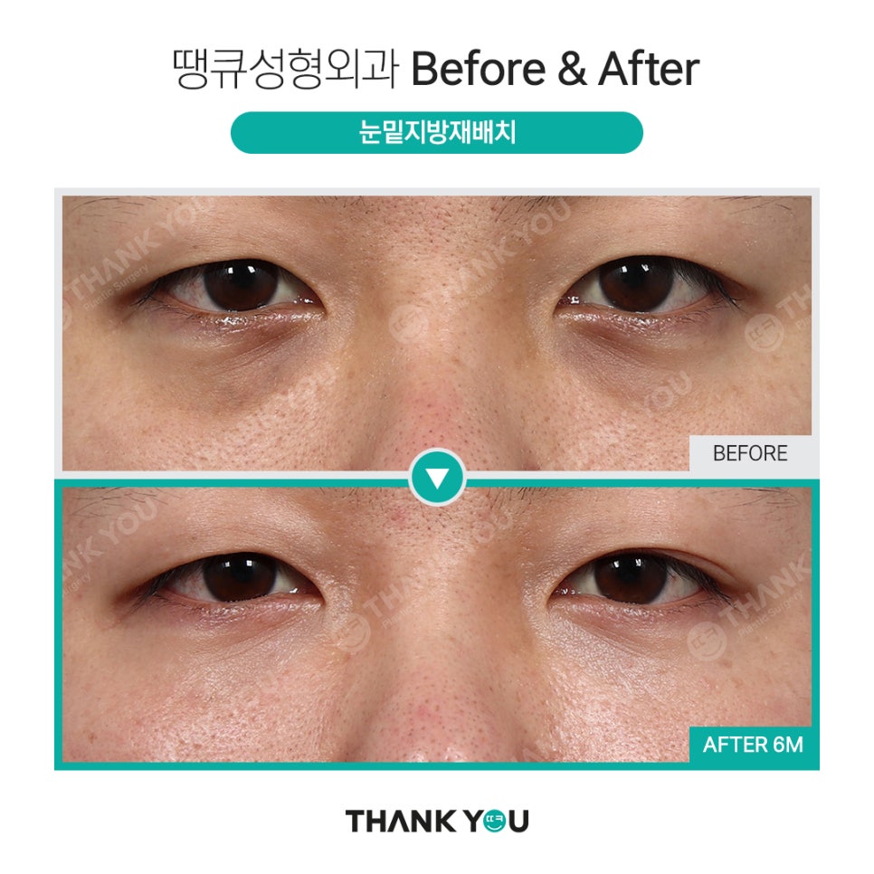 붐 눈밑지방재배치? 남자 눈밑지 전후 (붐, 남창희, 김동현) 관련 이미지 3
